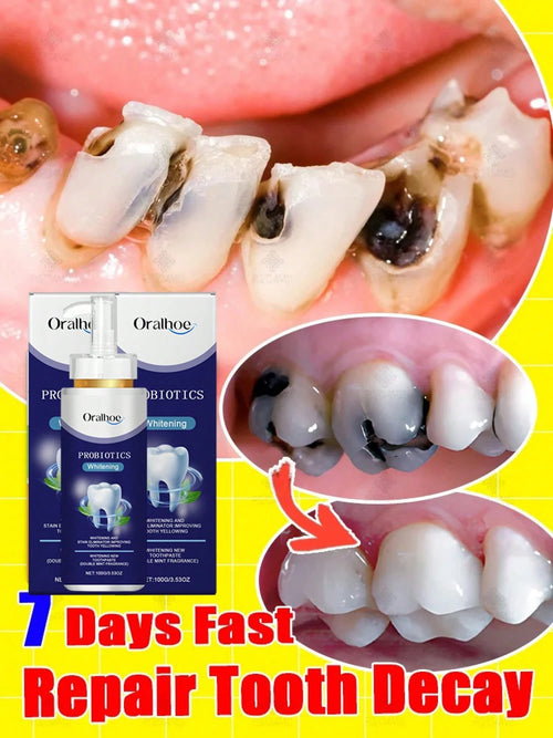 Teeth Cleaning Toothpaste Removes Tooth Stains Teeth Whitening Tooth Decay Repair Calculus Plaque Periodontitis Remove Cavities