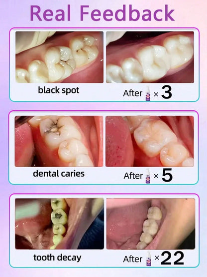Teeth Cleaning Toothpaste Removes Tooth Stains Teeth Whitening Tooth Decay Repair Calculus Plaque Periodontitis Remove Cavities